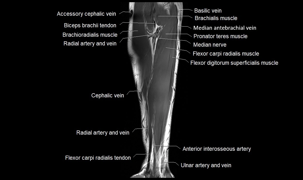 MRI 3T forearm coronal cross sectional anatomy image 7.webp